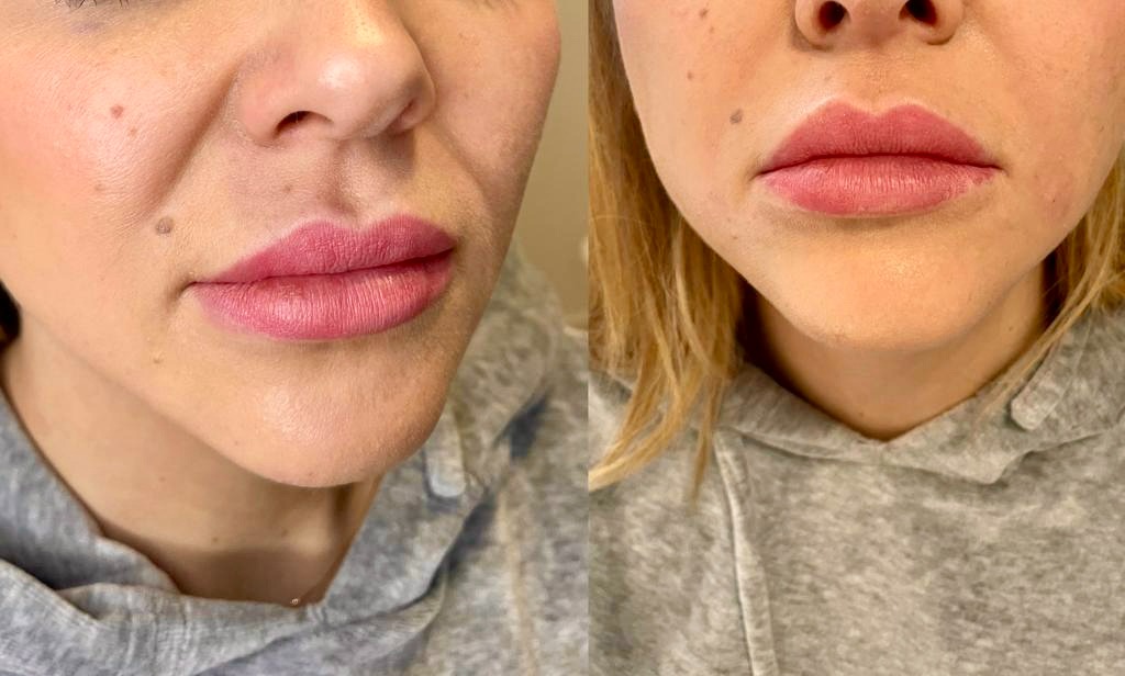 Zdjęcie 'przed i po' powiększenia ust kwasem hialuronowym. Widoczne zmiany w objętości i kształcie ust, redukcja zmarszczek wokół ust.