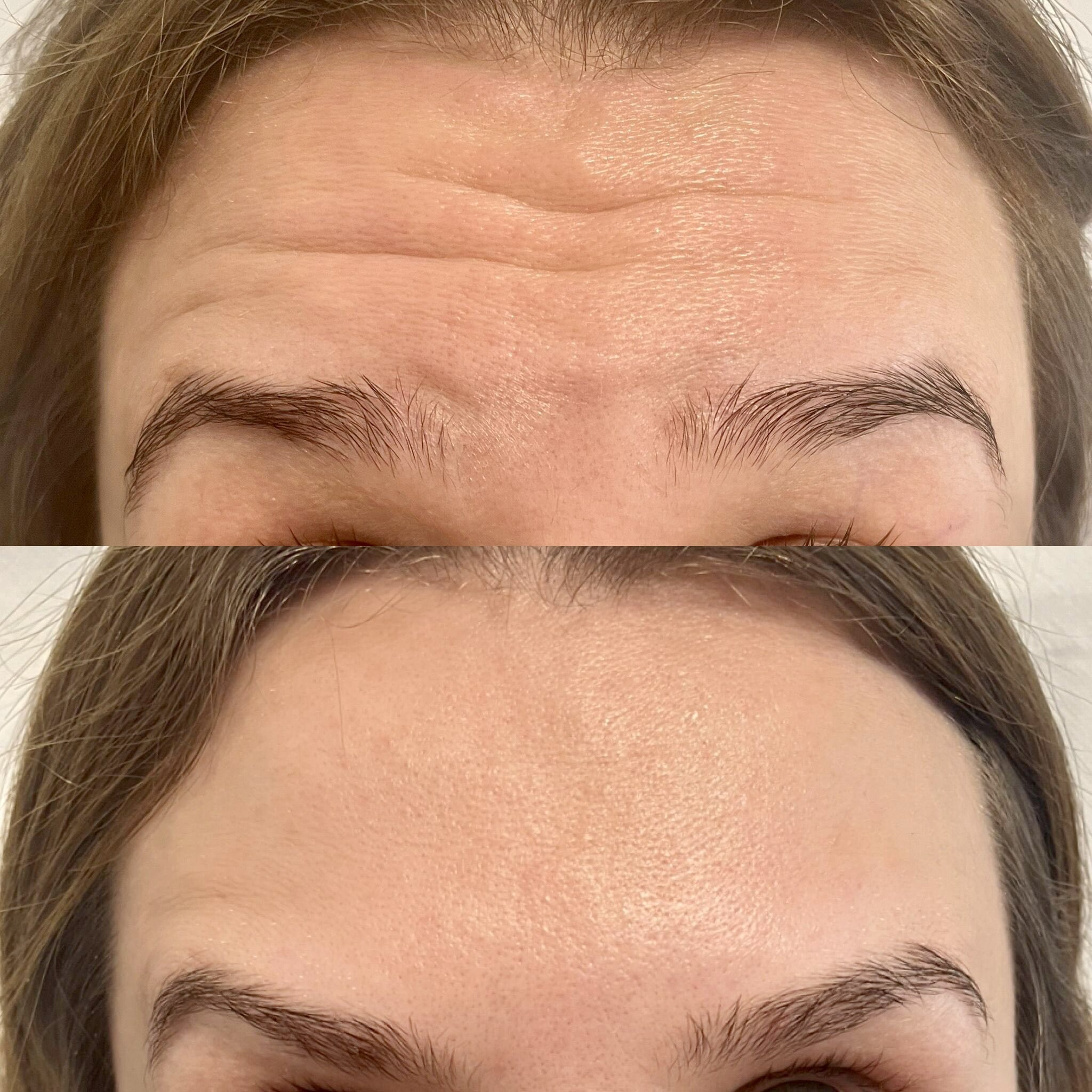 Zdjęcie 'przed i po' przedstawia redukcję zmarszczek mimicznych na czole kobiety, z widoczną poprawą gładkości skóry w górnej części zdjęcia.