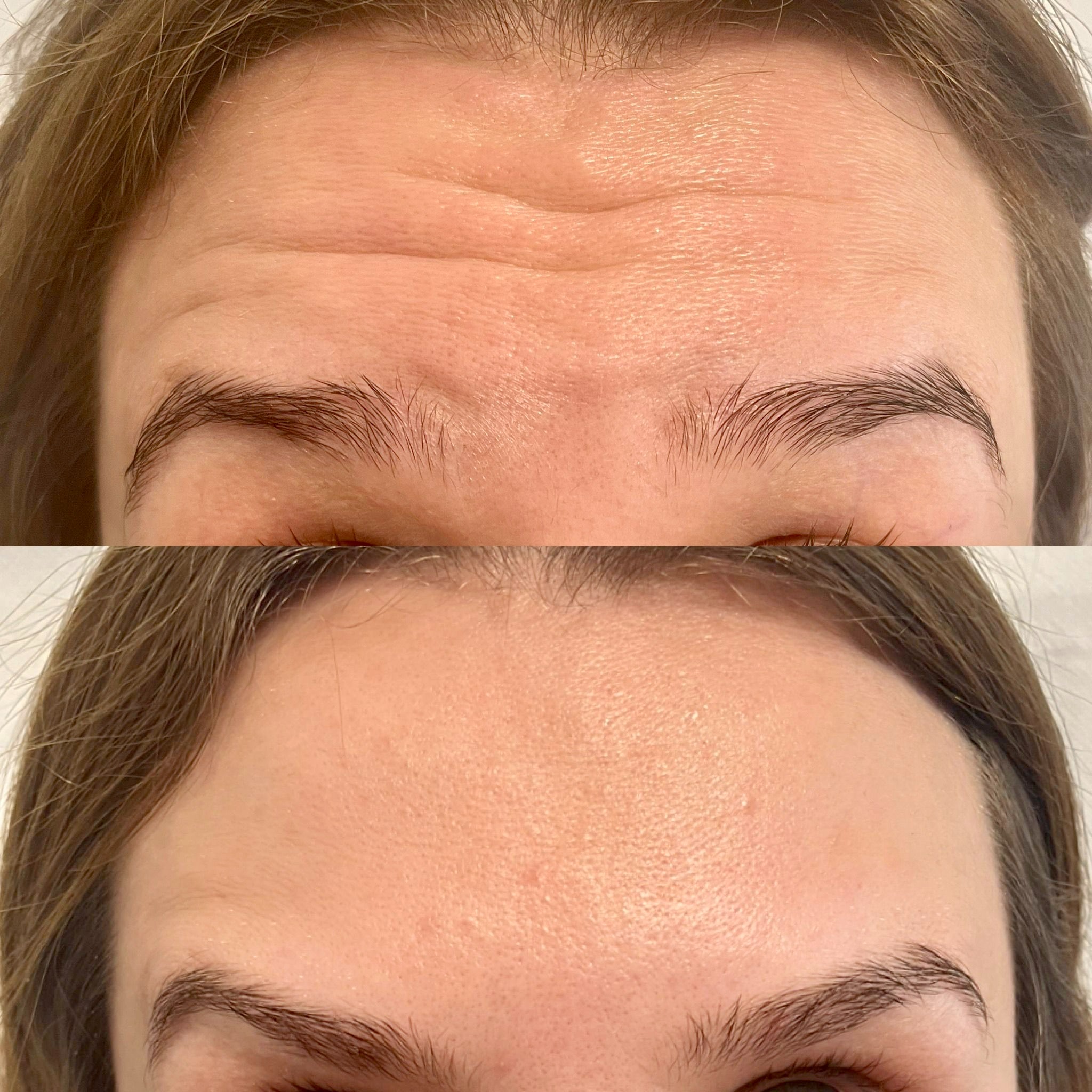 Zdjęcie porównawcze: czoło przed i po zabiegu redukcji zmarszczek mimicznych, widoczne wygładzenie skóry i redukcja linii.