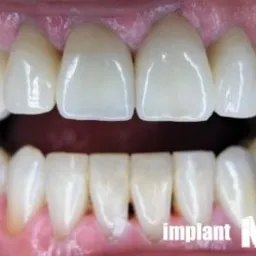 Bliski widok górnego i dolnego łuku zębowego po zabiegu, z widocznymi jasnymi, nowymi koronami na górnych zębach i naturalnymi, lekko przebarwionymi zębami dolnymi. W prawym dolnym rogu logo firmy.