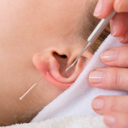 Akupunktura Częstochowa 3