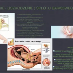 Ilustracja medyczna przedstawiająca porażenie splotu barkowego u noworodka, z zaznaczonymi obszarami uszkodzeń nerwów oraz zdjęciami niemowląt z objawami schorzenia.