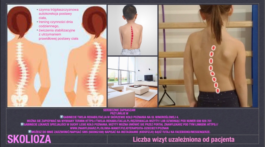 Kompozycja zdjęć ilustrująca skoliozę: schemat kręgosłupa, plecy dziecka z zaznaczonym skrzywieniem oraz dziecko przy drabinkach gimnastycznych z nałożonym schematem skrzywienia kręgosłupa...