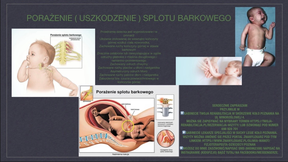 Ilustracja medyczna przedstawiająca porażenie splotu barkowego u noworodka, z zaznaczonymi obszarami uszkodzeń nerwów oraz zdjęciami niemowląt z objawami schorzenia.