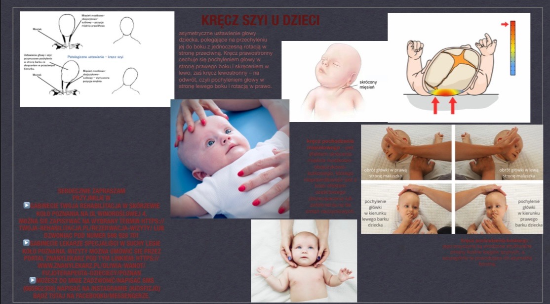 Infografika o kręczu szyi u dzieci, prezentująca różne techniki badania i terapii, w tym diagramy i zdjęcia niemowląt podczas badania palpacyjnego i ćwiczeń ruchowych.