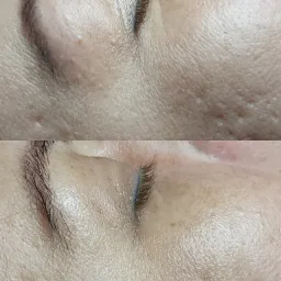 praca z bliznami - zabieg Dermaorganic AT