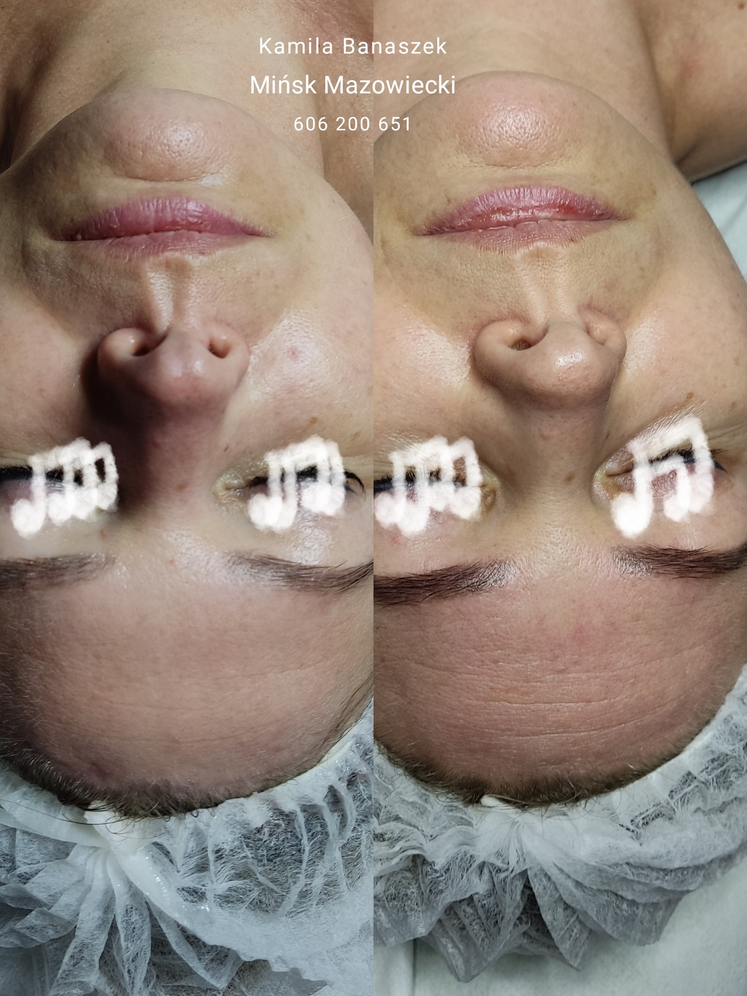 zamiast botoxu - nieinwazyjny, ekologiczny zabieg DermaOrganic AT