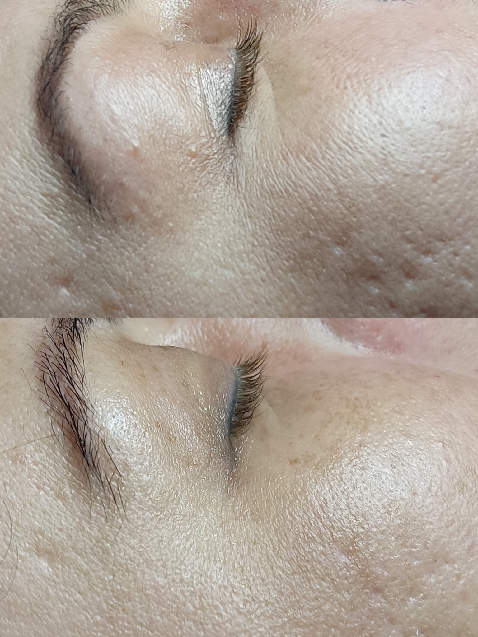 praca z bliznami - zabieg Dermaorganic AT