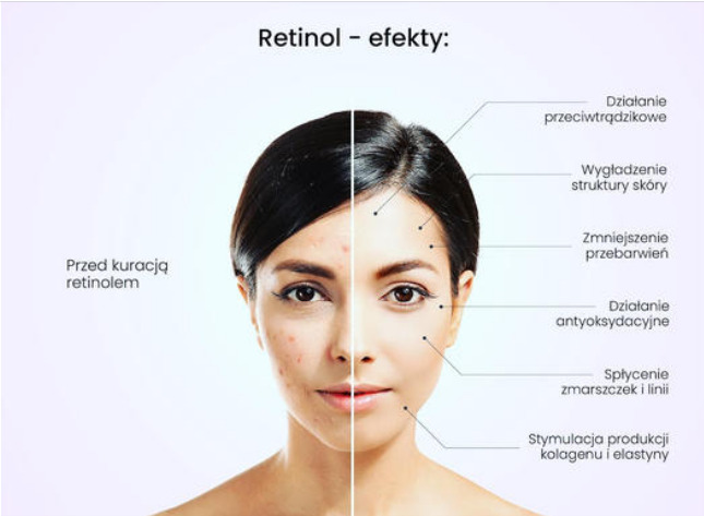 Porównanie skóry twarzy przed i po kuracji retinolem, ukazujące redukcję trądziku, przebarwień i zmarszczek oraz poprawę struktury skóry i stymulację kolagenu.