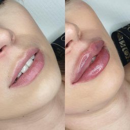 Burghardt.Clinic - Zbliżenie na usta przed i po zabiegu powiększania, widoczne różnice w objętości i kolorze, ujęcie z boku twarzy.