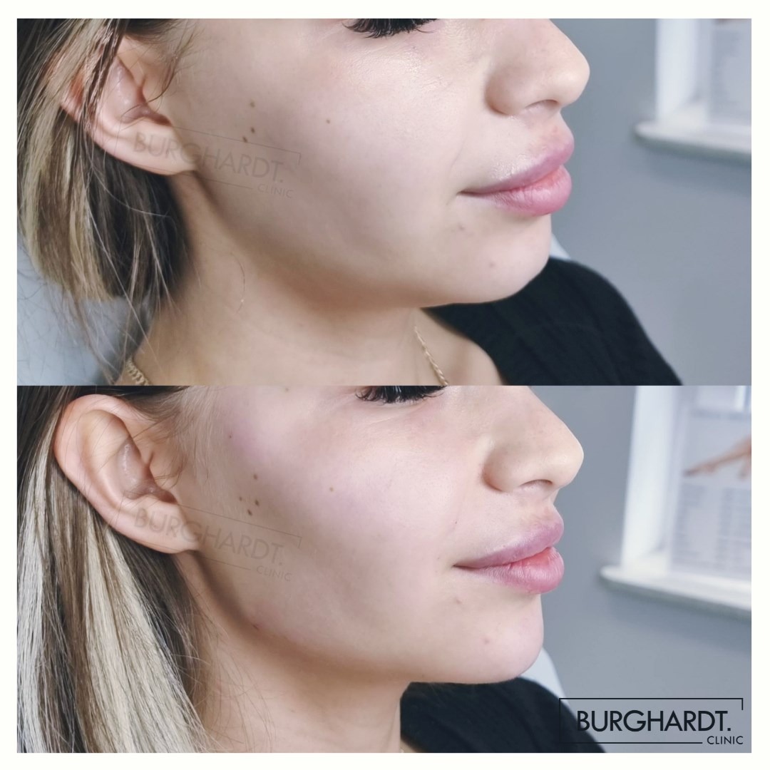 Porównanie profilu twarzy kobiety przed i po zabiegu, uwydatnione usta i linia żuchwy, widoczne logo kliniki w prawym dolnym rogu.