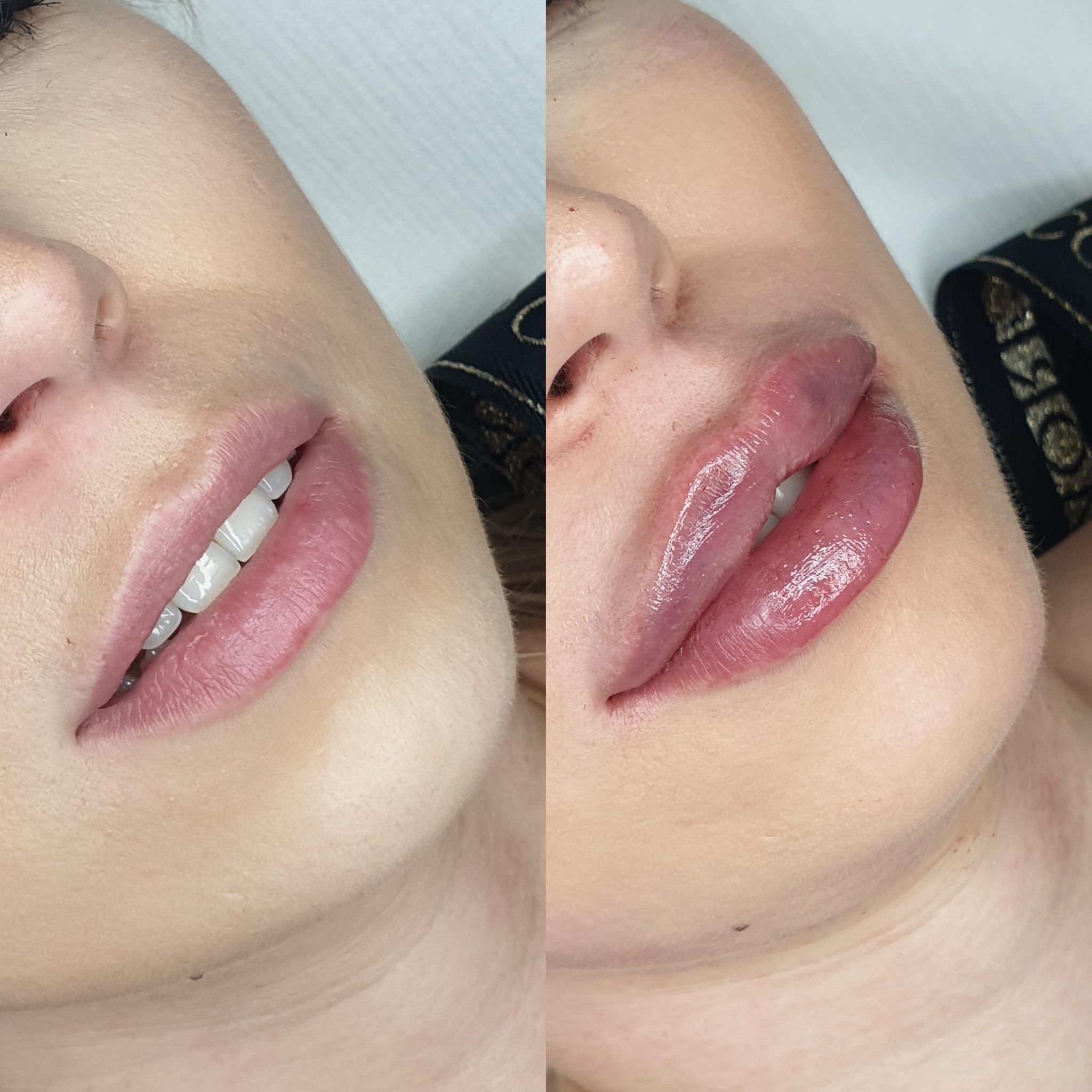 Zbliżenie na usta przed i po zabiegu powiększania, widoczne różnice w objętości i kolorze, ujęcie z boku twarzy.