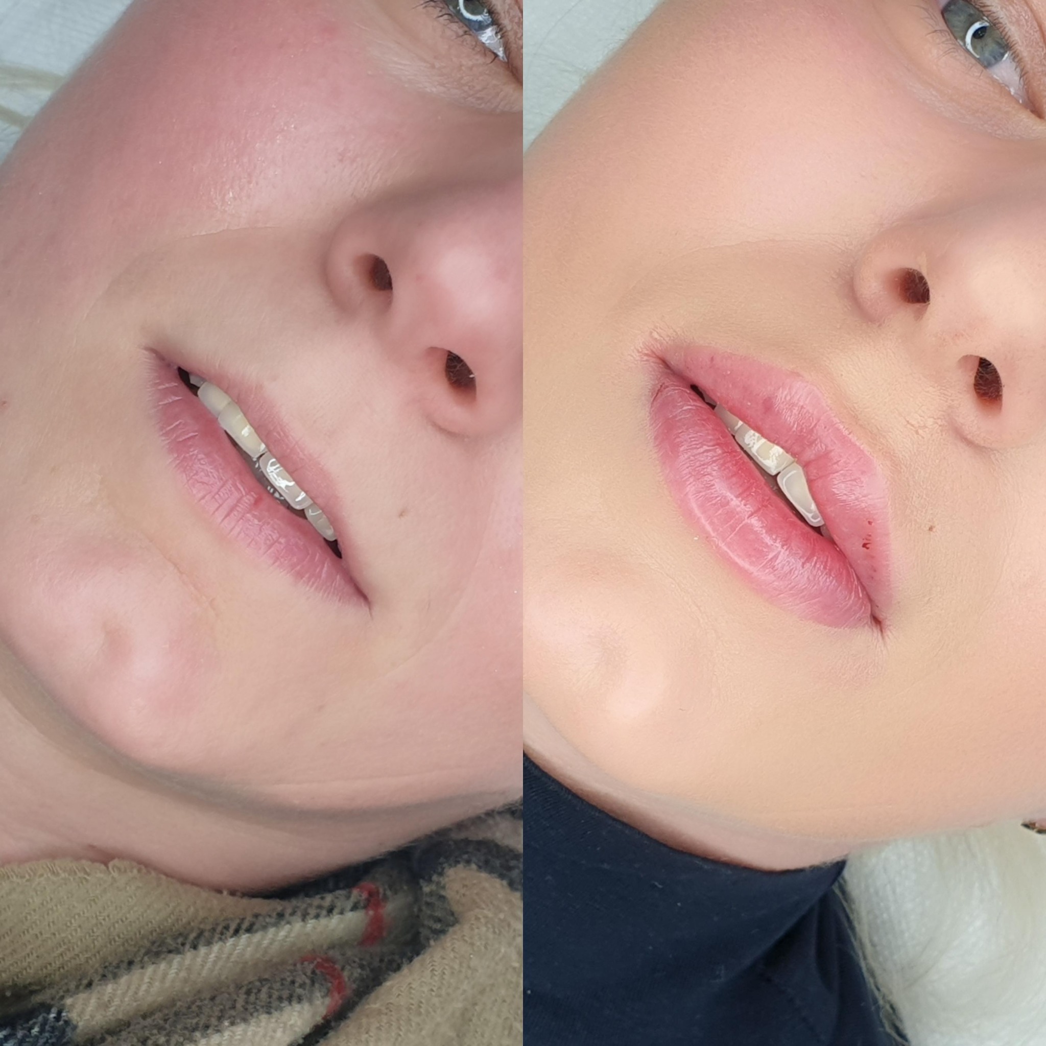 Zbliżenie na usta kobiety przed i po zabiegu powiększenia i modelowania. Po lewej stronie usta naturalne, po prawej - powiększone i wyraźnie podkreślone konturem.