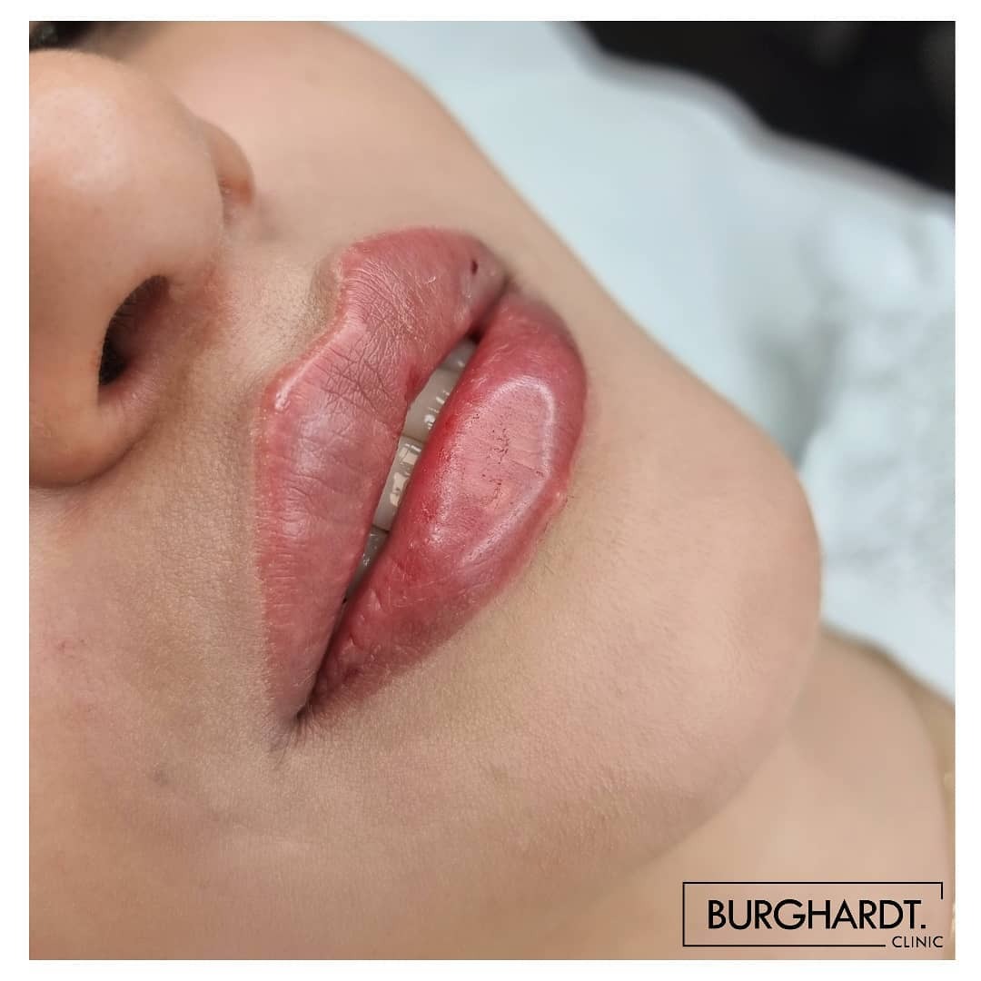 Zbliżenie na kobiece usta po zabiegu pigmentacji, widoczne świeże, czerwono-różowe zabarwienie i podkreślony kontur ust, na skórze wokół ust widoczne zaczerwienienia po zabiegu, w tle logo kliniki.