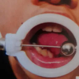 Zbliżenie ust z rozwieraczem stomatologicznym i lusterkiem w jamie ustnej, widoczne zęby i język.