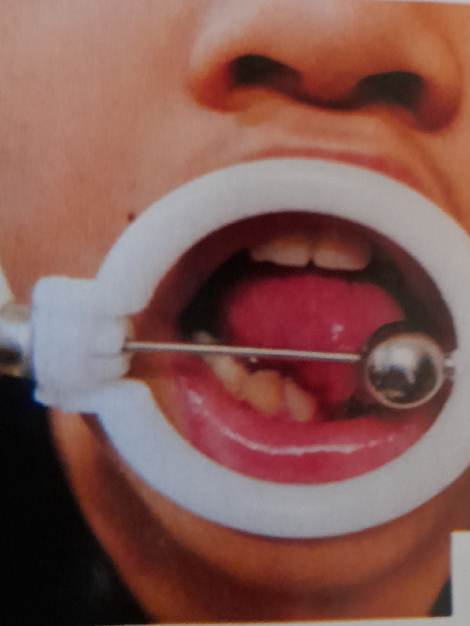 Zbliżenie ust z rozwieraczem stomatologicznym i lusterkiem w jamie ustnej, widoczne zęby i język.