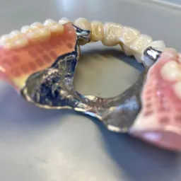 Metalowa proteza szkieletowa z akrylowymi elementami imitującymi dziąsła i porcelanowymi zębami, leżąca na szarym tle.