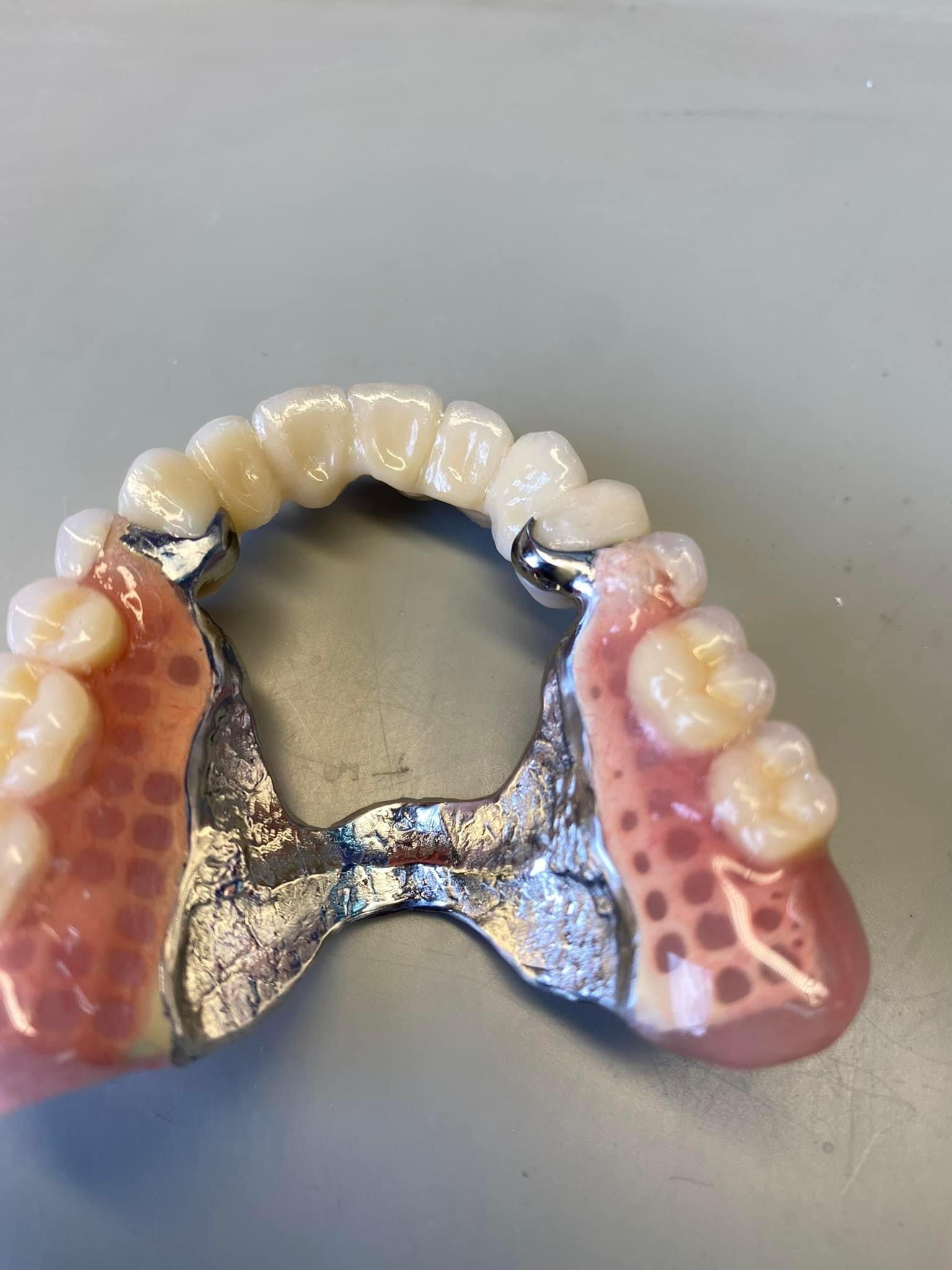 Wyjmowana proteza szkieletowa z akrylową płytą i metalową konstrukcją, widoczne sztuczne zęby i imitacja dziąseł na szarym tle.