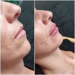 Zbliżenie na profil twarzy kobiety przed i po zabiegu powiększania ust, widoczne subtelne zmiany w objętości i kształcie, skóra lekko zaczerwieniona, w tle ciemna tapeta w kwiatowy wzór.