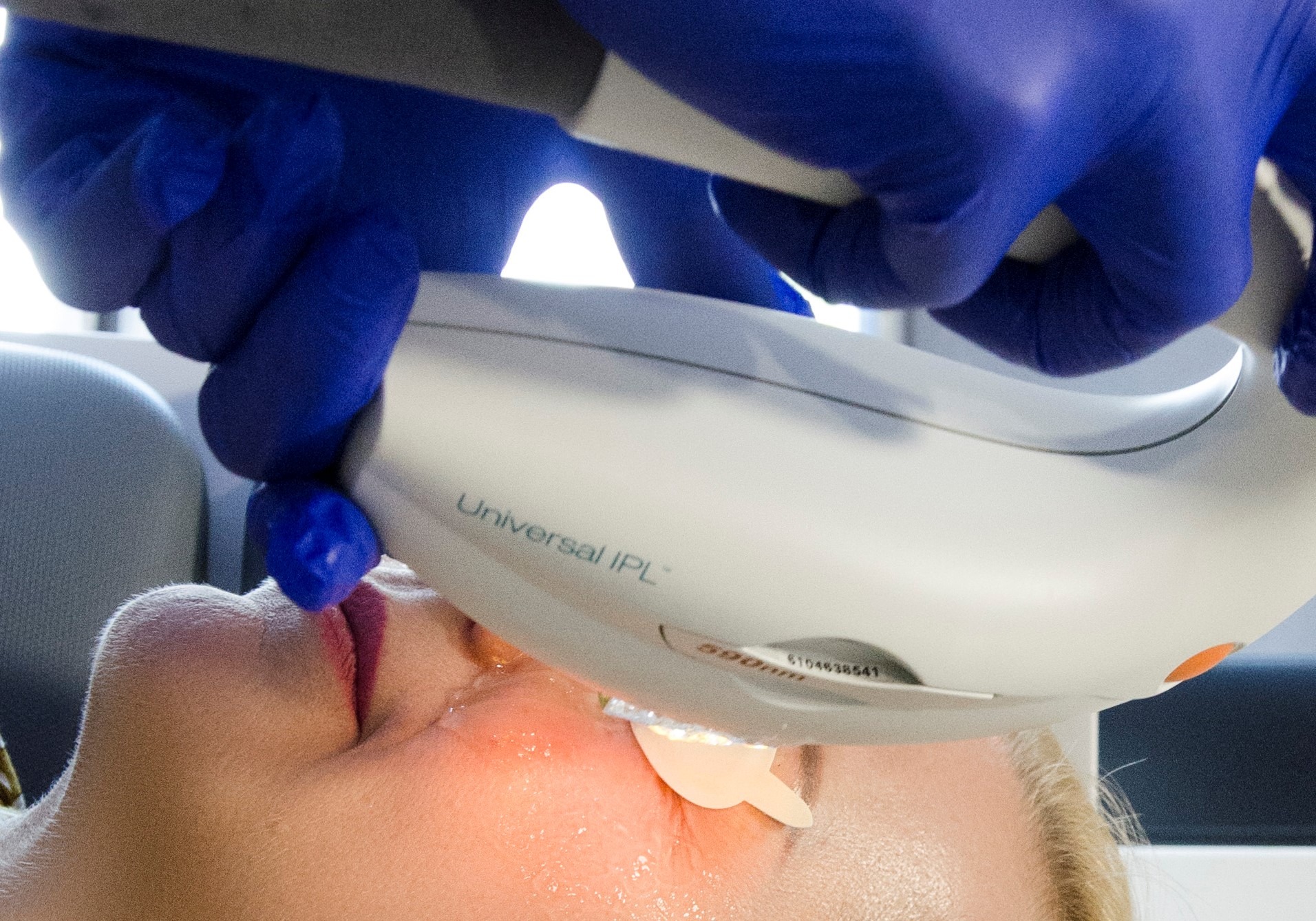 Zabieg IPL na twarzy pacjentki z użyciem urządzenia Universal IPL 590nm, wykonywany przez osobę w niebieskich rękawiczkach.