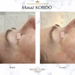 Porównanie skóry wokół oczu przed i po serii masaży Kobido: redukcja zmarszczek i poprawa napięcia skóry.