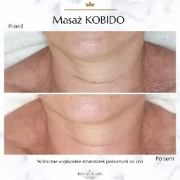 Zdjęcie 'przed i po' prezentujące wygładzenie zmarszczek poziomych na szyi, po serii zabiegów. Widoczne zbliżenie na skórę szyi pacjentki.