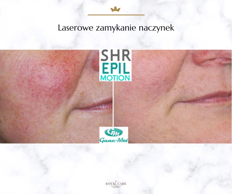 Porównanie skóry policzka przed i po zabiegu laserowego zamykania naczynek, widoczne zmniejszenie zaczerwienienia i poprawa kolorytu, z logo SHR Epil Motion i Ganc-Med.
