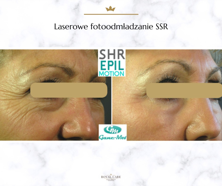 Porównanie skóry pod oczami przed i po laserowym fotooodmładzaniu SSR, widoczne zmarszczki przed zabiegiem i wygładzona skóra po, z zasłoniętymi oczami dla zachowania anonimowości.