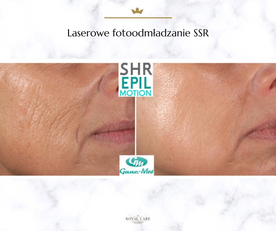 Zbliżenie na skórę twarzy przed i po laserowym foto-odmładzaniu SSR, widoczne zmniejszenie zmarszczek i poprawa tekstury skóry.