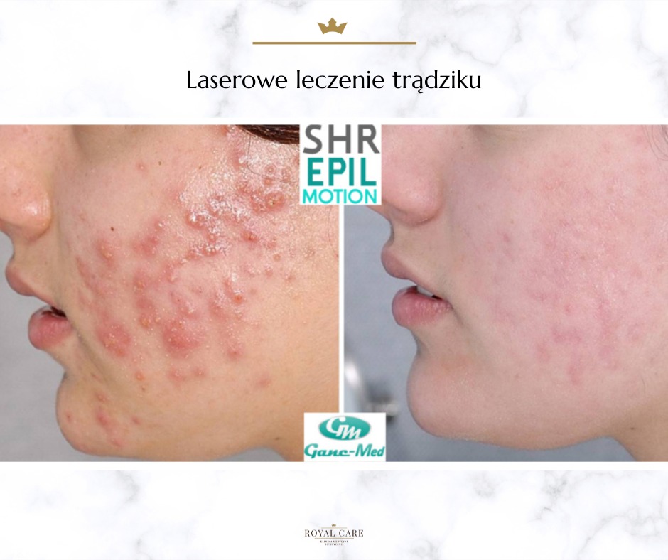 Zdjęcie typu 'przed i po' prezentujące efekt laserowego leczenia trądziku na policzku pacjenta, widoczne zaczerwienienia i zmiany skórne po lewej stronie oraz poprawa stanu skóry po prawej stronie.
