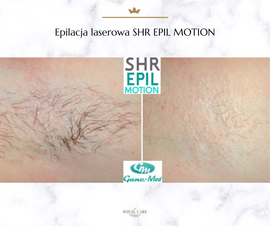 Zdjęcie typu 'przed i po' prezentujące efekt depilacji laserowej SHR EPIL MOTION, widoczne włoski przed zabiegiem po lewej stronie i gładka skóra po prawej stronie, na marmurkowym tle z logotypami.