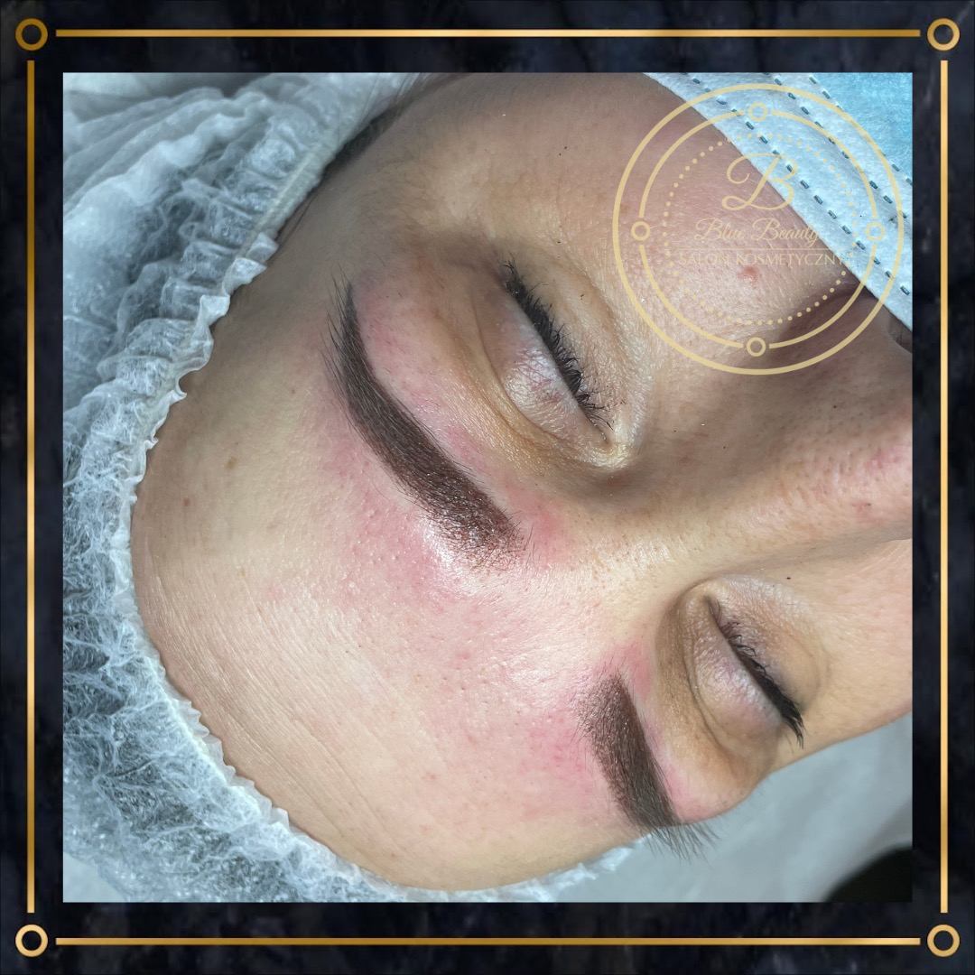 Blizna na skroni po zabiegu makijażu permanentnego brwi, widoczne zaczerwienienie skóry.