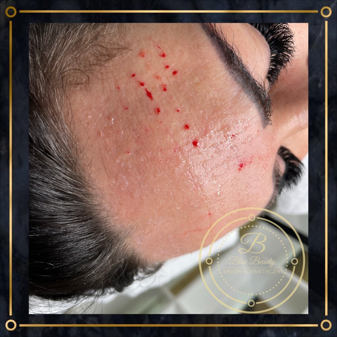 Skóra twarzy po zabiegu z widocznymi drobnymi śladami krwi, podkreślone brwi i widoczne rzęsy, logo salonu kosmetycznego w rogu.