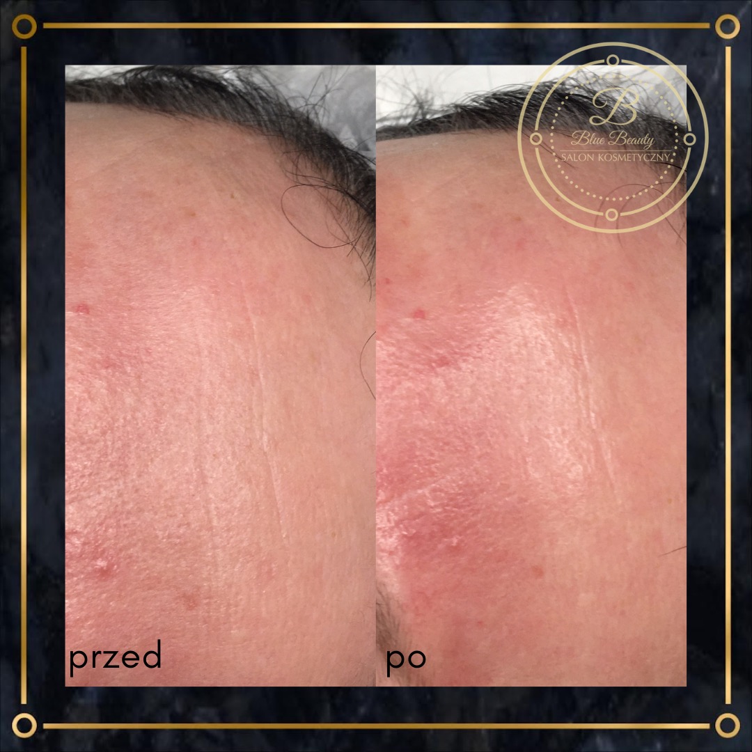 Porównanie skóry czoła przed i po zabiegu kosmetycznym, widoczne zmniejszenie zaczerwienienia i poprawa tekstury skóry, z logo salonu kosmetycznego w prawym górnym rogu.