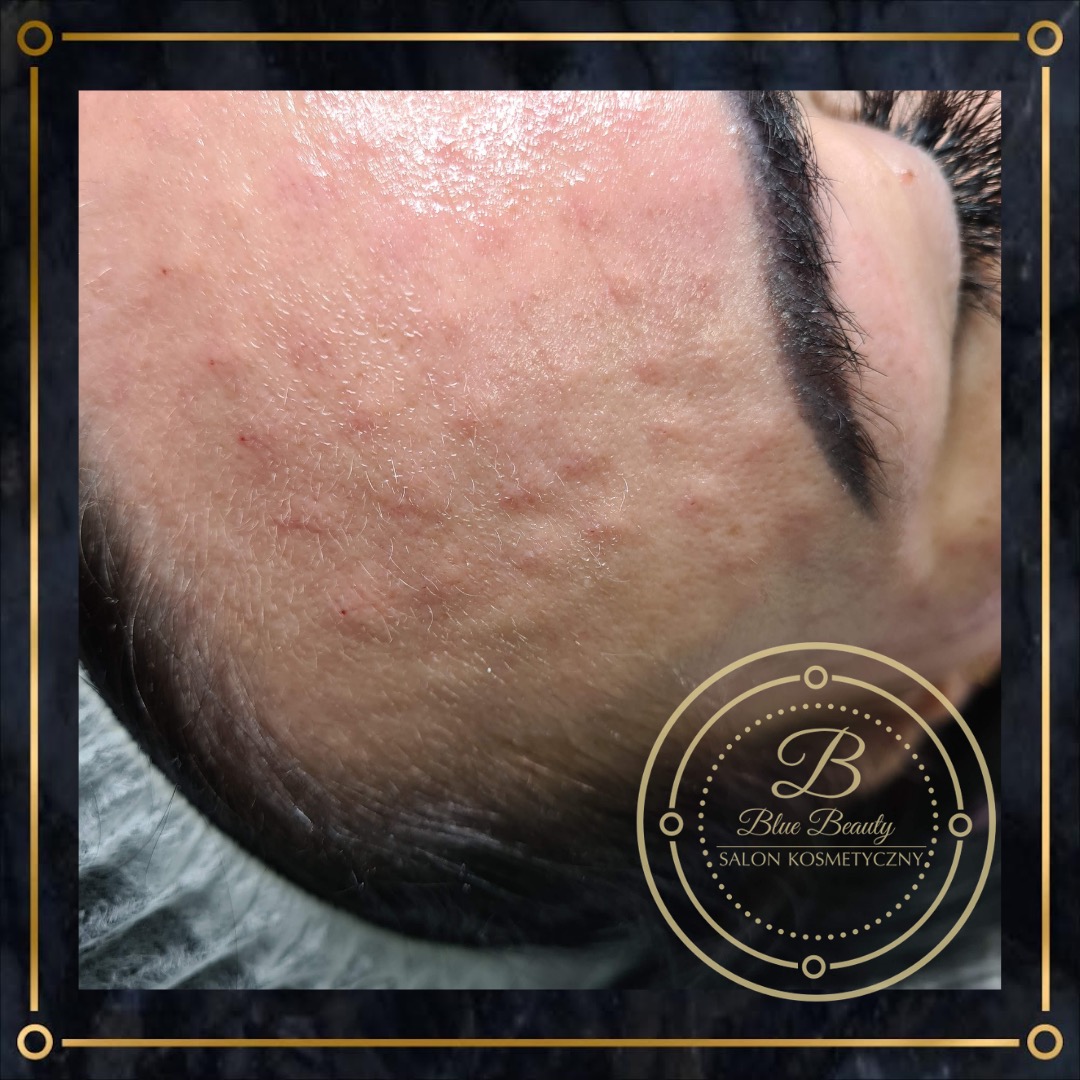 Zbliżenie na skórę twarzy klientki po zabiegu, widoczne zaczerwienienia i pory, zarys brwi z makijażem permanentnym, w rogu logo salonu.