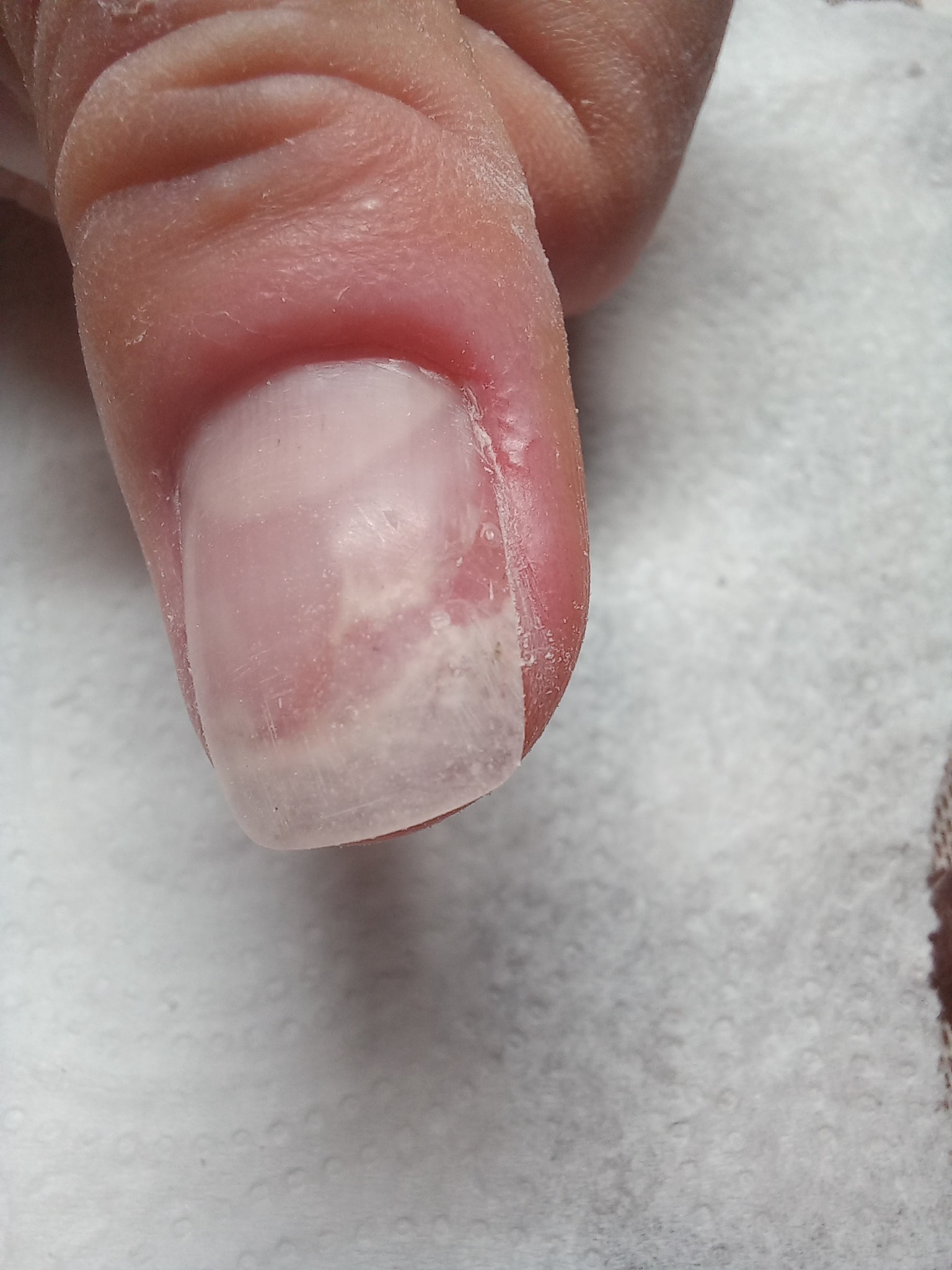 paznokieć po rekonstrukcji