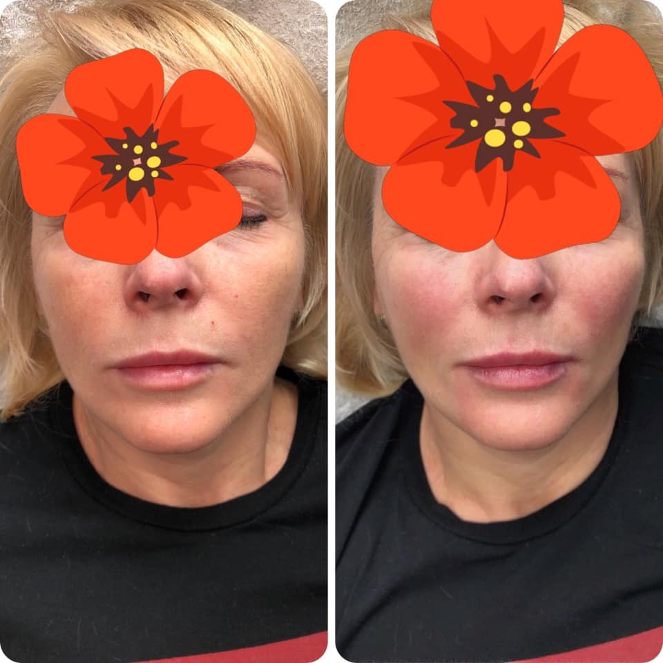 Zdjęcie 'przed i po' przedstawia twarz kobiety z widocznymi efektami zabiegu kosmetycznego, uwidaczniając różnicę w wyglądzie skóry przed i po interwencji. Na zdjęciu po prawej stronie widać...