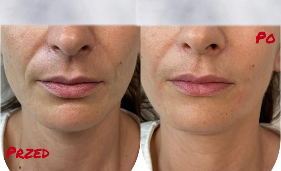 Zdjęcie typu 'przed i po' przedstawiające dolną część twarzy kobiety, ukazujące redukcję zmarszczek i poprawę napięcia skóry po zabiegu kosmetycznym.