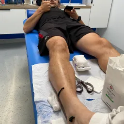 Przewlekły stan zapalny mięśnia strzałkowego. Typowe dla biegaczy.