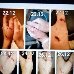 Klientka pokaleczyła dłonie przy sprzątaniu, , na zdjęciu widać  efekt terapii, już po czterech niach.