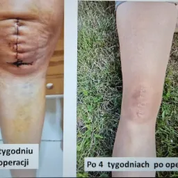 Noga po operacji kolana: zdjęcie porównawcze blizny po 1 i 4 tygodniach od zabiegu. Widoczne postępy w gojeniu.