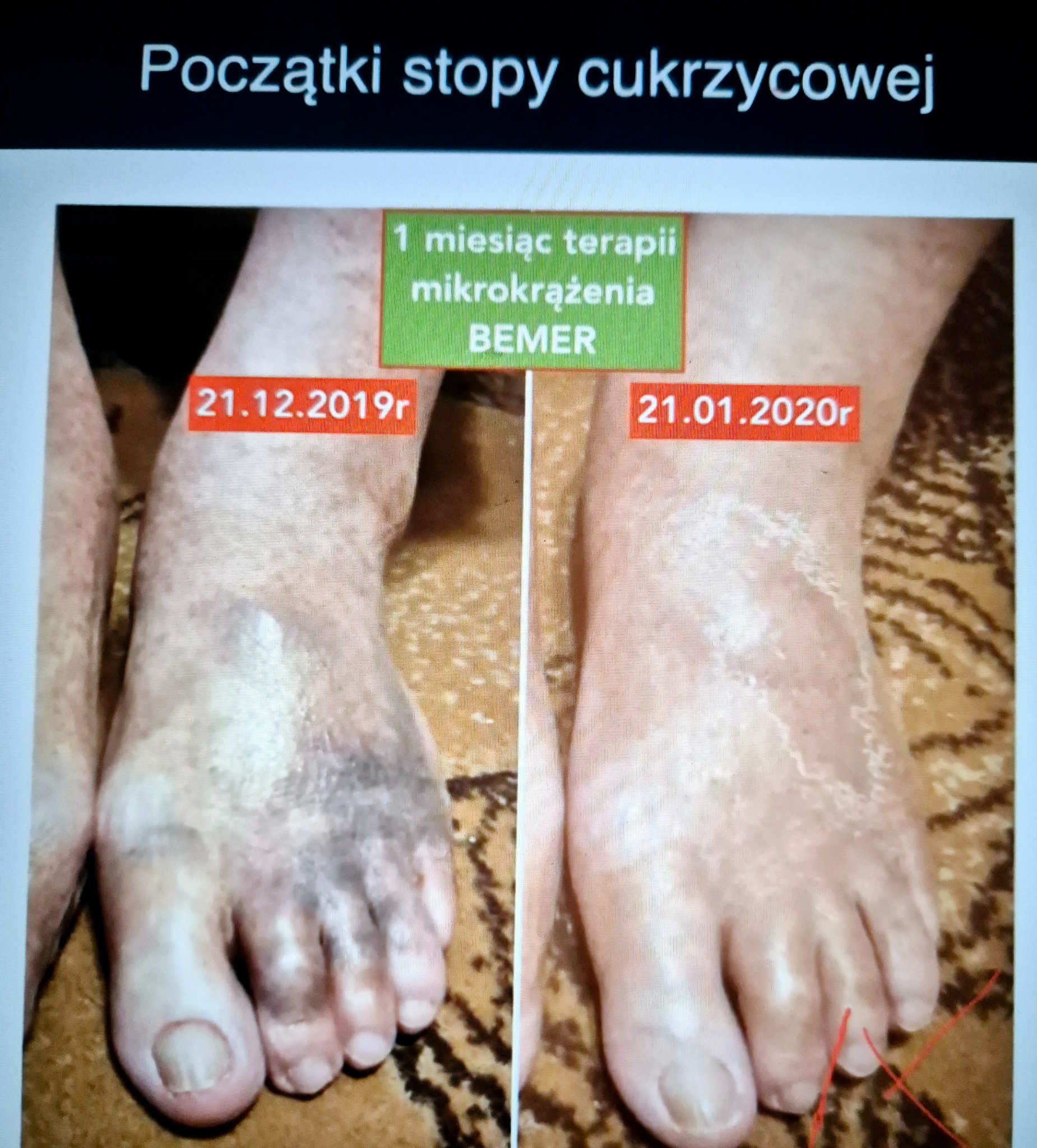Porównanie stóp przed i po miesięcznej terapii mikrokrążenia BEMER, widoczne zmiany w wyglądzie skóry i redukcja zasinień na palcach.