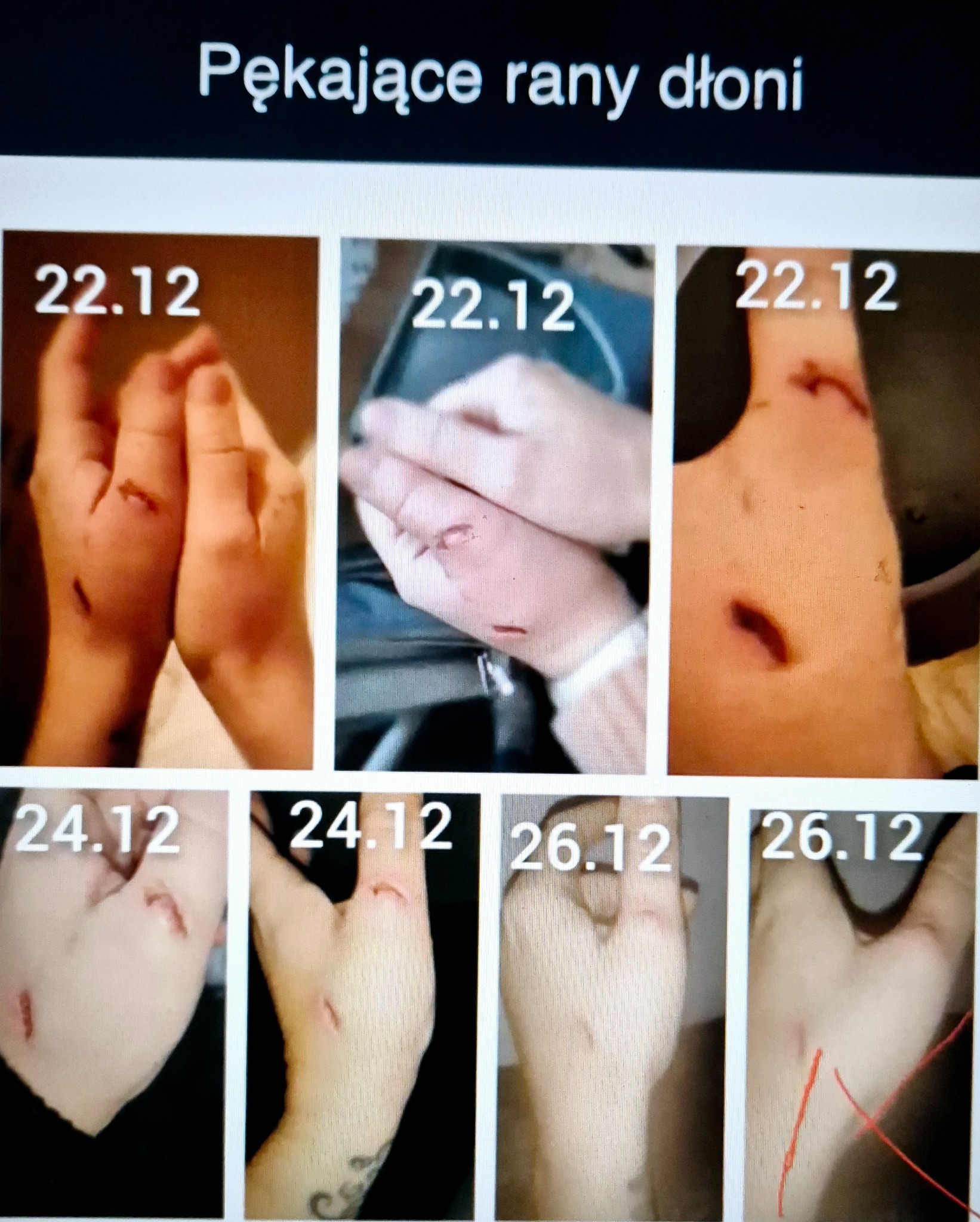 Klientka pokaleczyła dłonie przy sprzątaniu, , na zdjęciu widać efekt terapii, już po czterech niach.