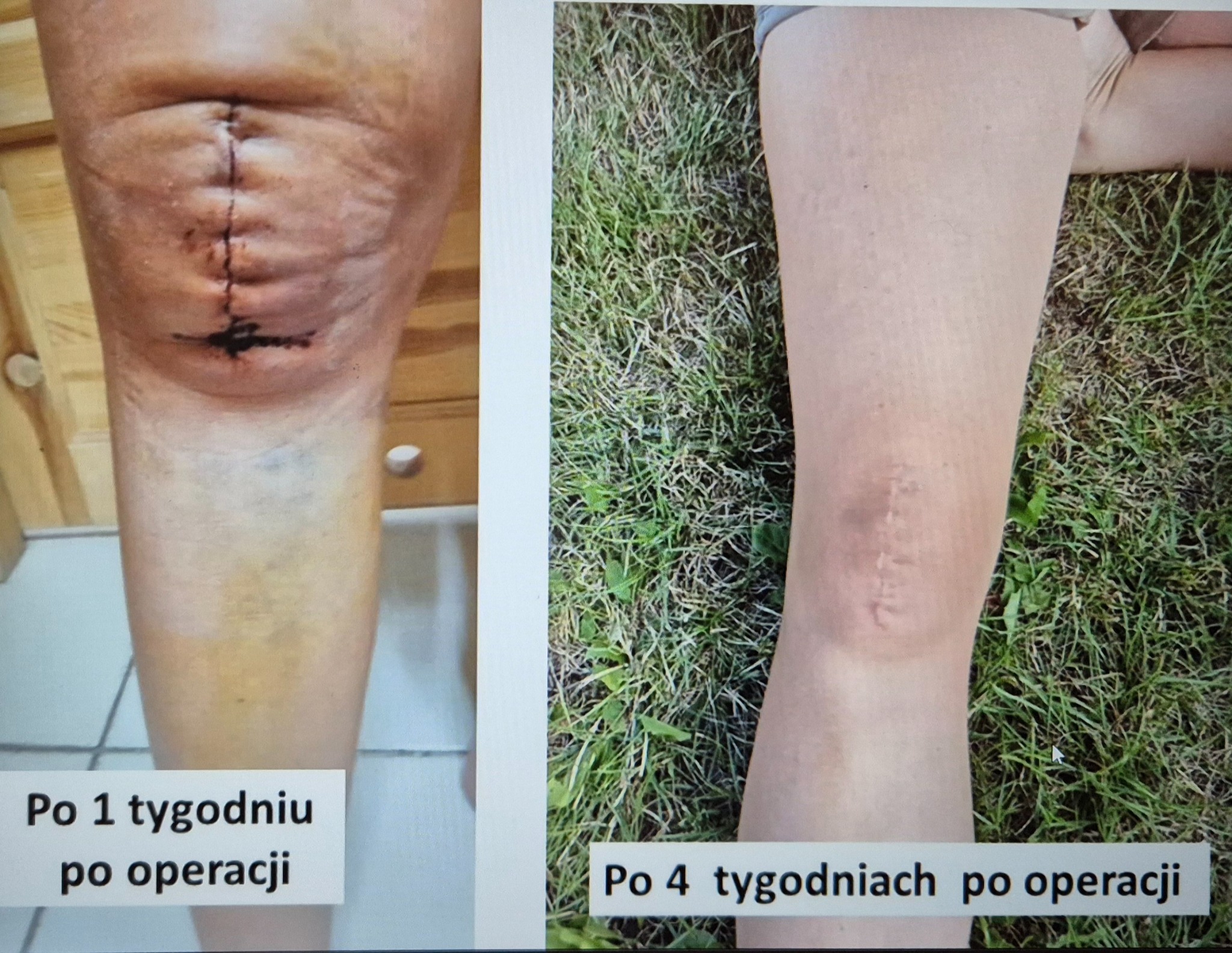 Noga po operacji kolana: zdjęcie porównawcze blizny po 1 i 4 tygodniach od zabiegu. Widoczne postępy w gojeniu.