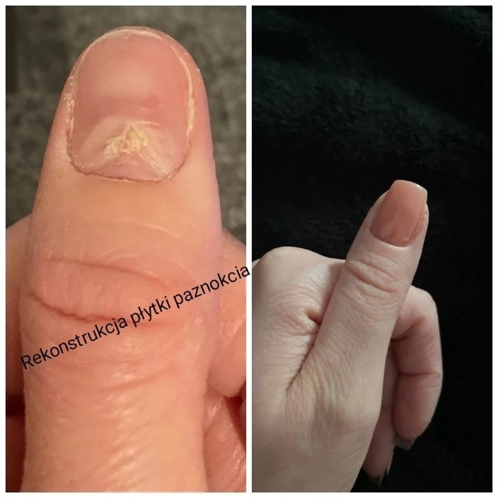 Zdjęcie porównawcze kciuka przed i po rekonstrukcji płytki paznokcia, widoczne uszkodzenie i efekt po zabiegu z nałożonym żelem.