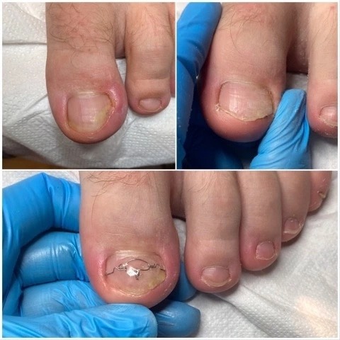 Kolaż zdjęć stopy przed, w trakcie i po założeniu klamry ortonyksyjnej na wrastający paznokieć dużego palca, widoczne dłonie w niebieskich rękawiczkach.