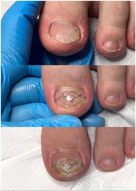 Korekcja wrastającego paznokcia z użyciem klamry ortonyksyjnej, widok z bliska na trzy etapy zabiegu: przed, w trakcie i po założeniu klamry, drugi palec stopy bez klamry.
