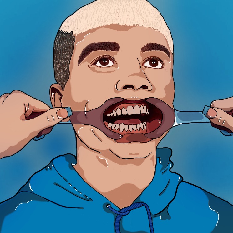 Ilustracja przedstawiająca młodego mężczyznę z blond włosami i niebieską bluzą, z otwartymi ustami rozwartymi przez plastikowy przyrząd dentystyczny trzymany przez dwie ręce.