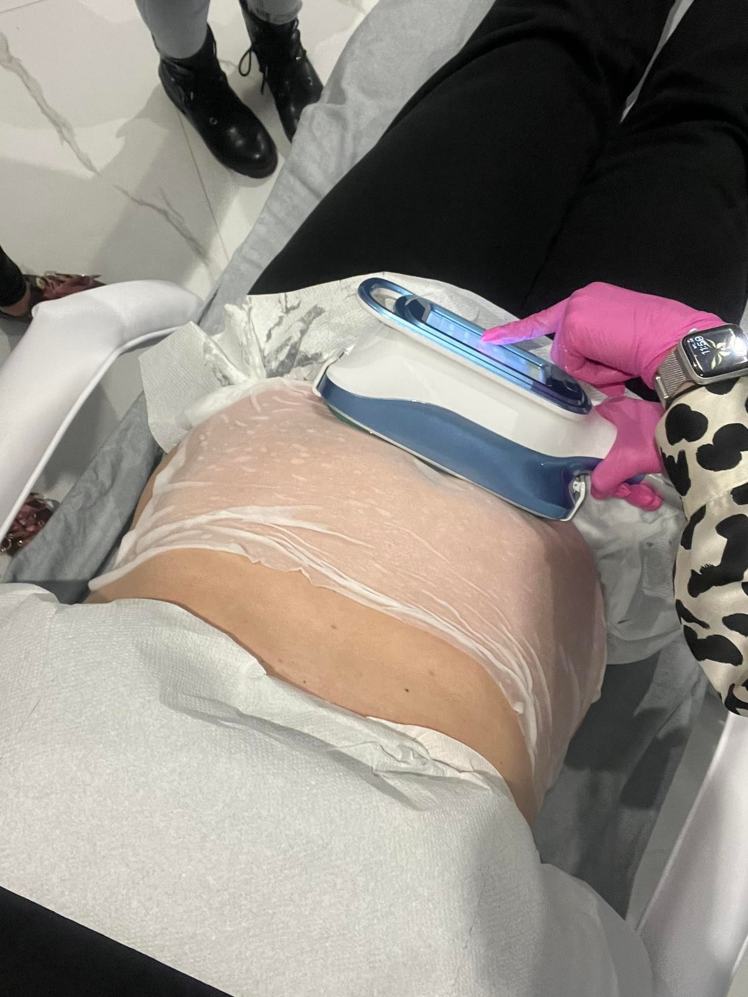 Kobieta leżąca na leżance podczas zabiegu na brzuch, pokrytym białym kremem, wykonywanego urządzeniem z niebieskimi elementami przez osobę w różowych rękawiczkach i bluzce w czarno-białe łaty...