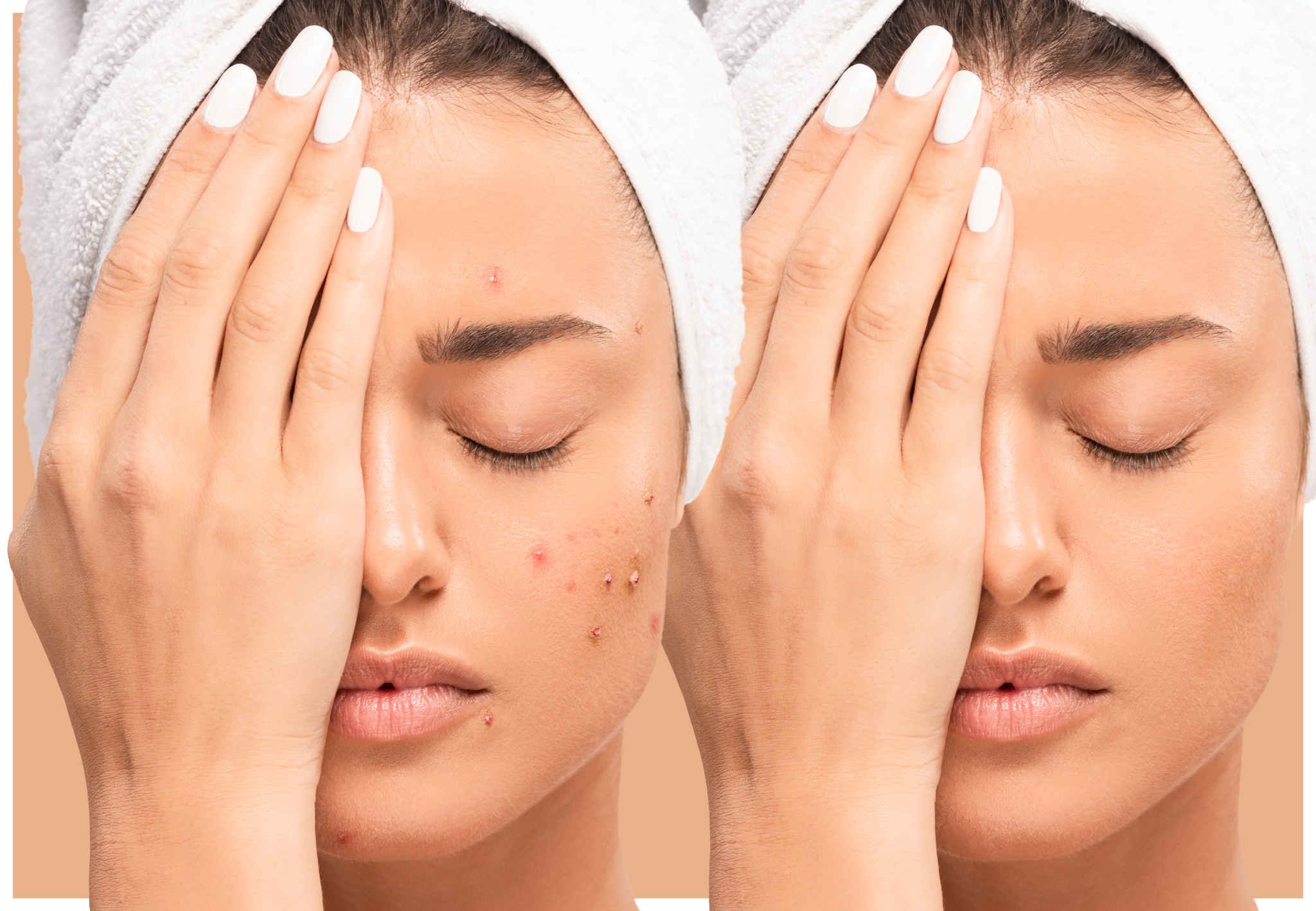 Porównanie skóry twarzy przed i po zabiegu: po lewej stronie widoczne zmiany trądzikowe, po prawej skóra gładka. Kobieta z zamkniętymi oczami, z ręcznikiem na głowie i dłonią zakrywającą część twarzy.